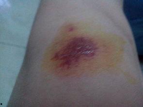 吃瓜伤口流水,揭秘吃瓜伤口流水的惊人真相